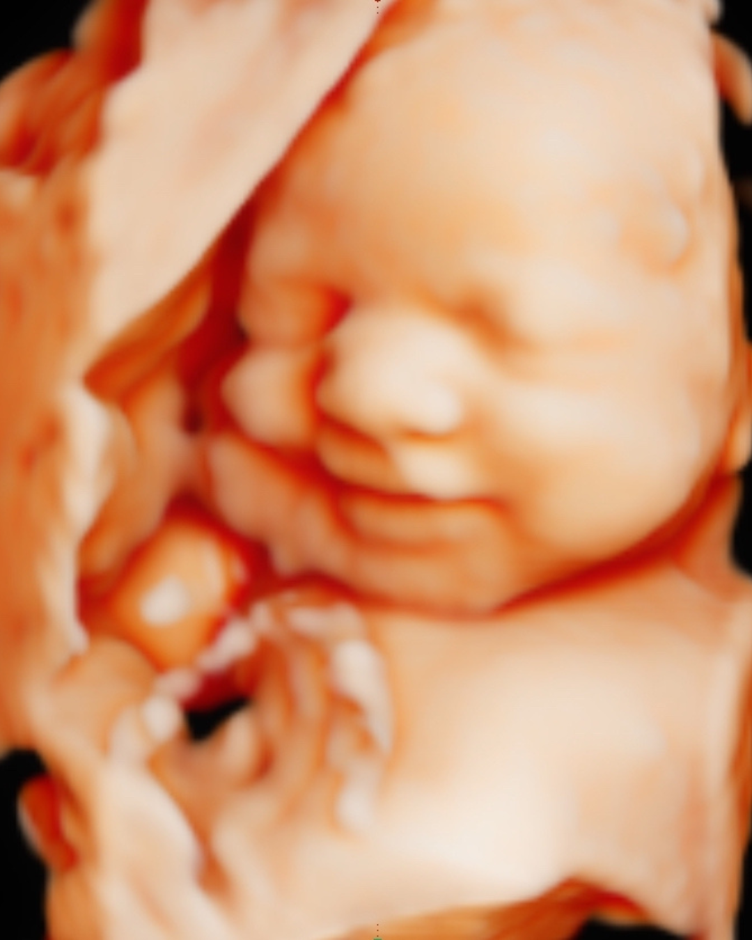 Gender Reveal Blood Test